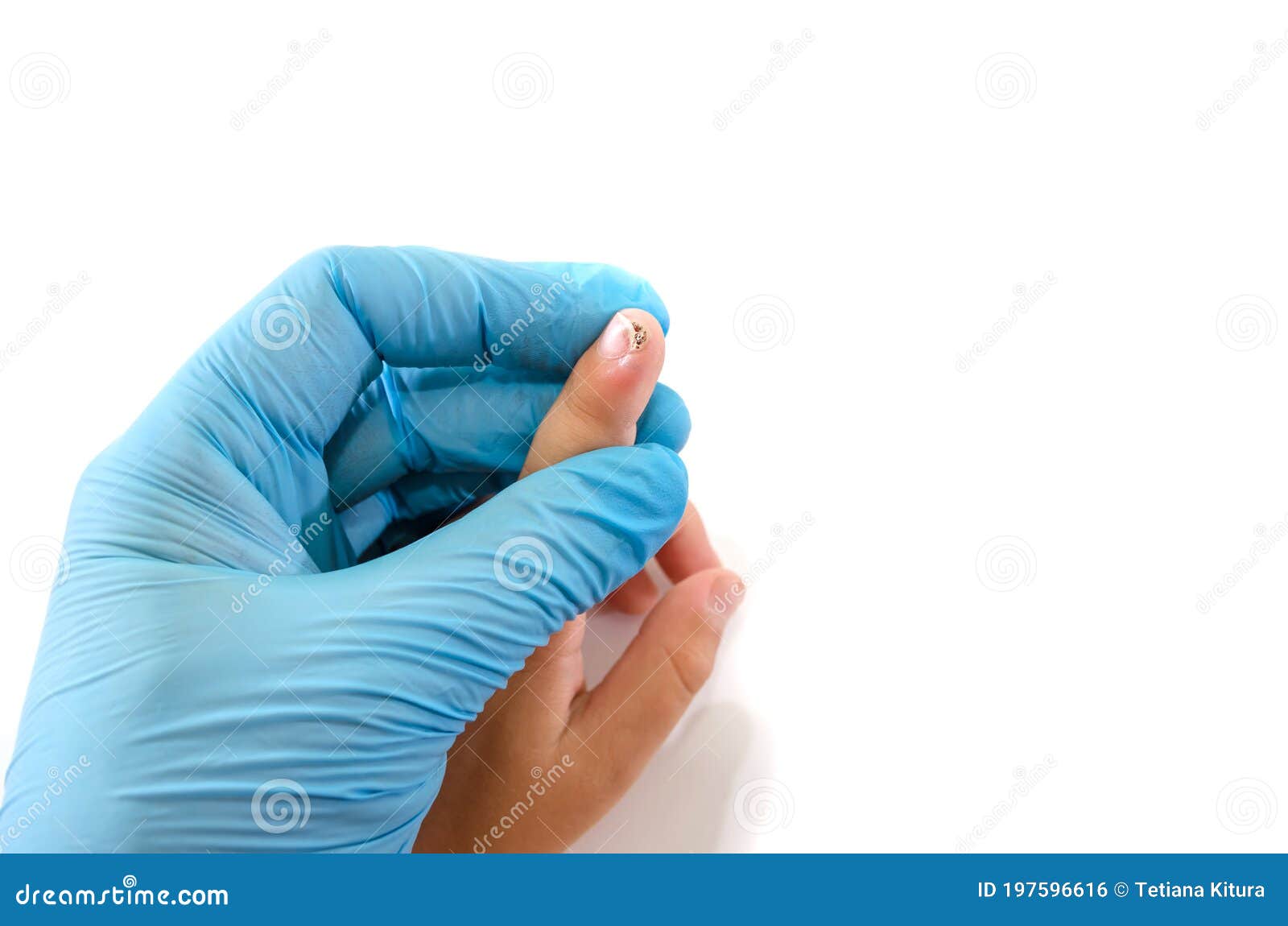 Human papillomavirus warts on hands treatment, Hpv virus treatment