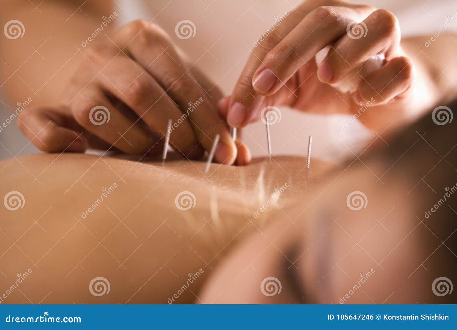 the doctor sticks needles into the girl`s body on the acupuncture