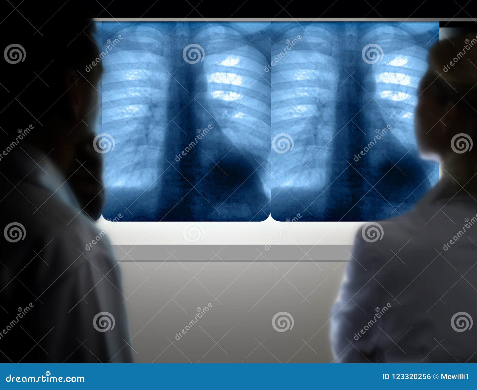 doctors diagnosing lung cancer from x-ray