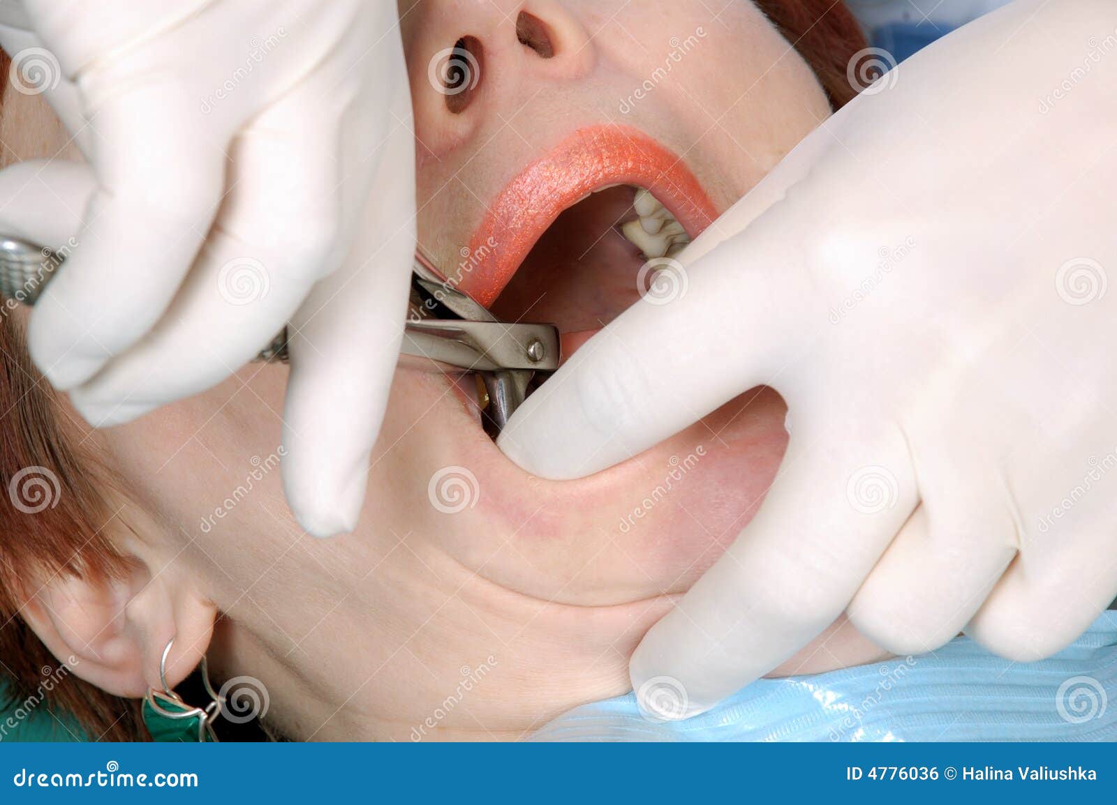 doctors hands extract a tooth from woman