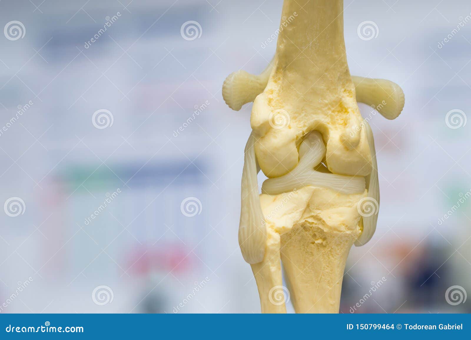 Mri Lateral Meniscus Tear Pathology RoyaltyFree Stock Image