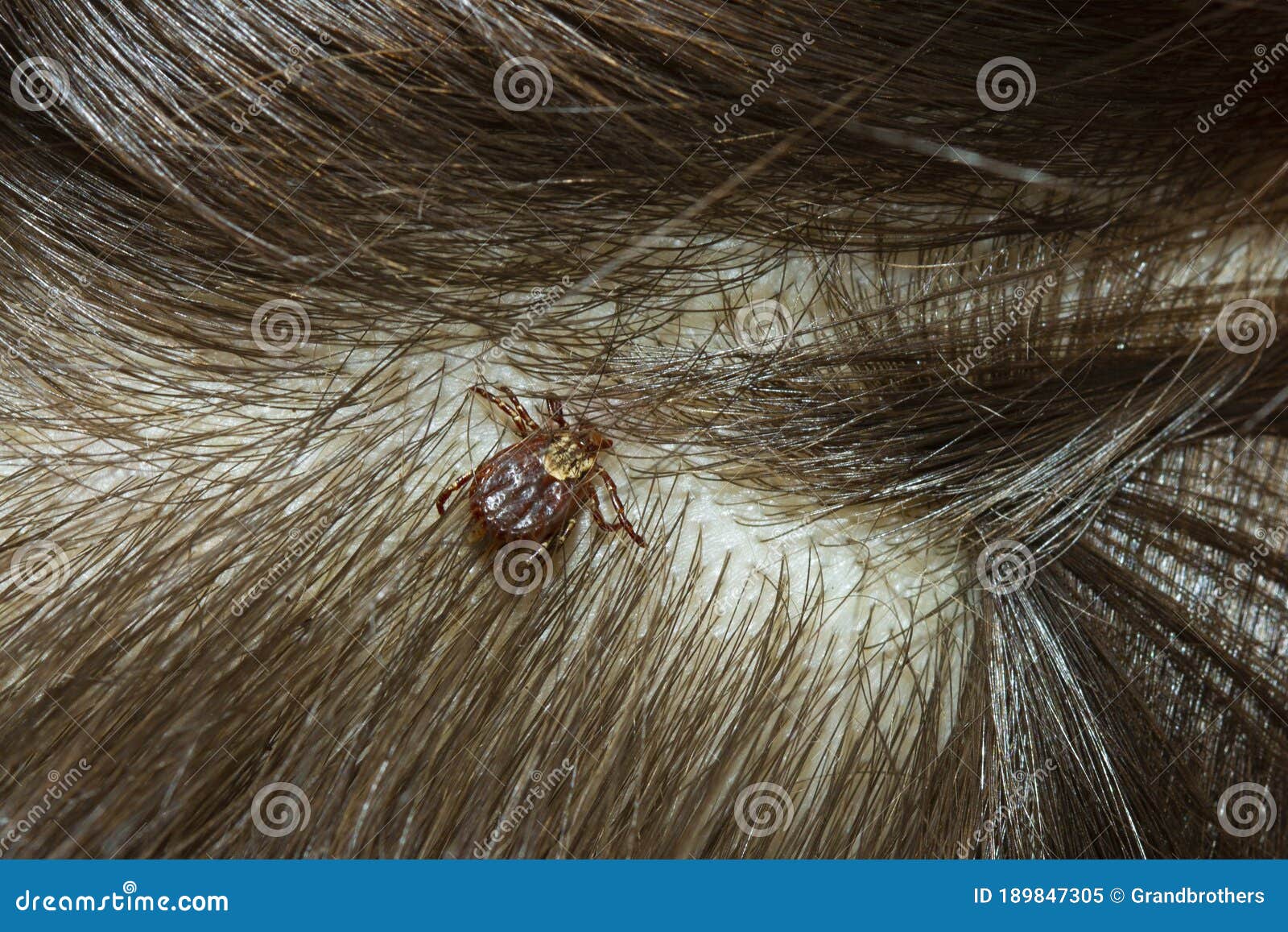Tick stumbling through human hair  Stock Video Clip  K0036569  Science  Photo Library