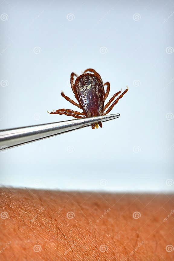 Dog Tick Removal stock photo. Image of human, anaplasmosis 21818246