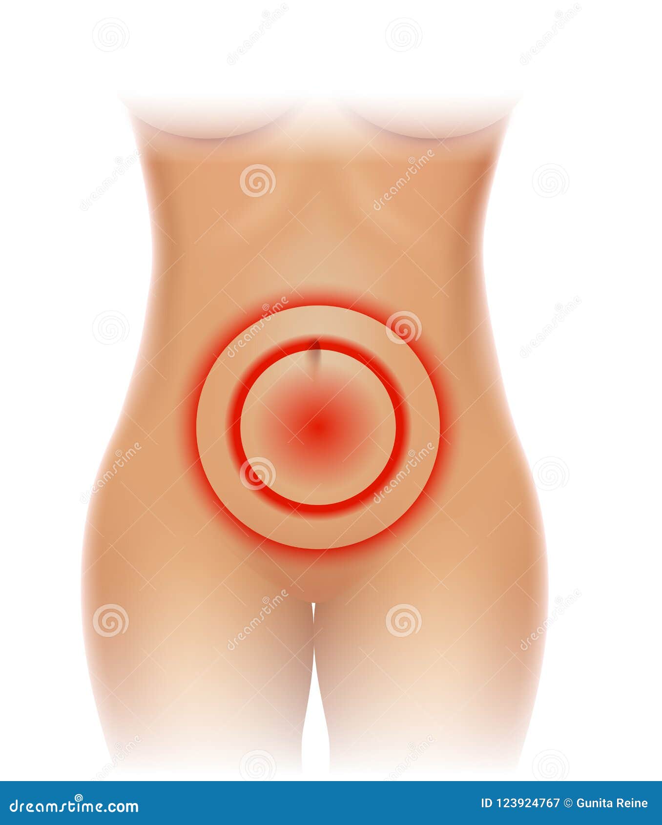 áreas de dolor pélvico áreas de dolor pélvico