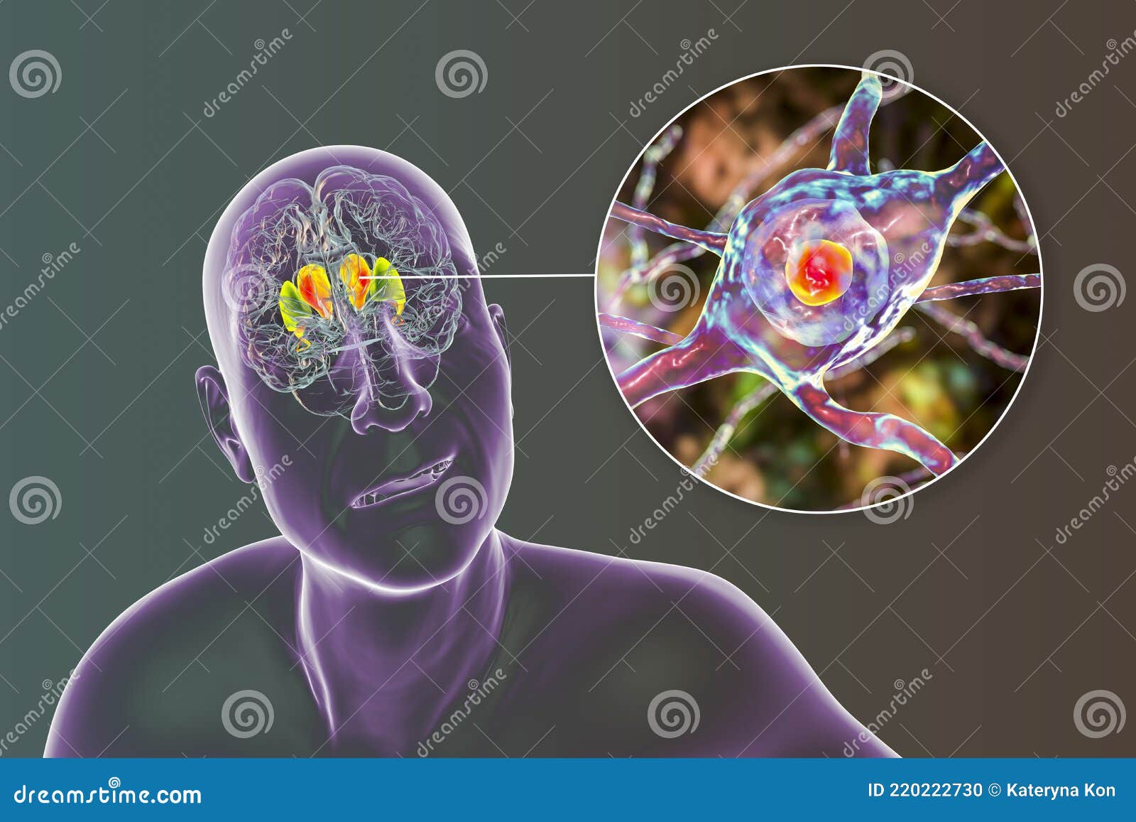 dorsal striatum highlighted in the brain of a person with chorea disease and close-up view of neuronal degradation