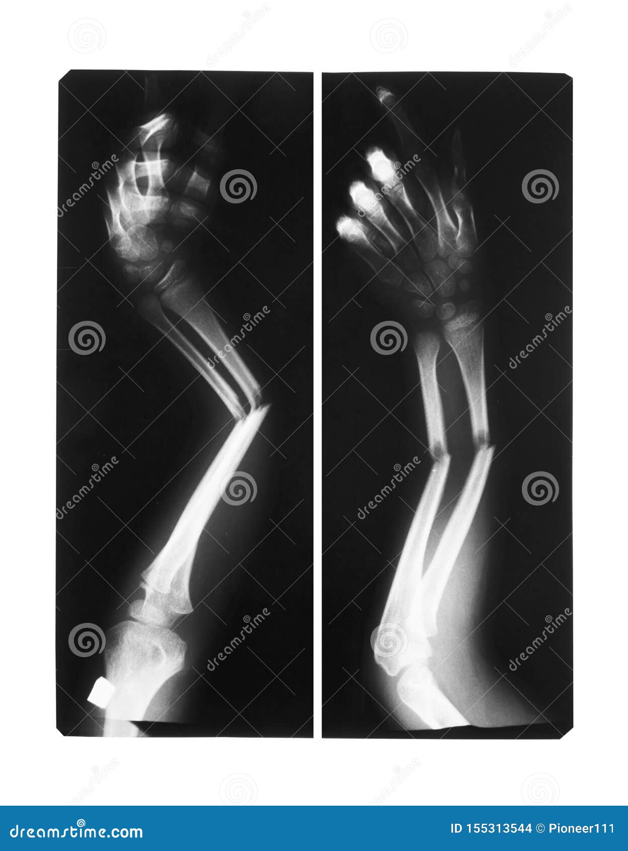 Doubles Os De Bras De Fracture D'exposition Photo stock - Image du ...