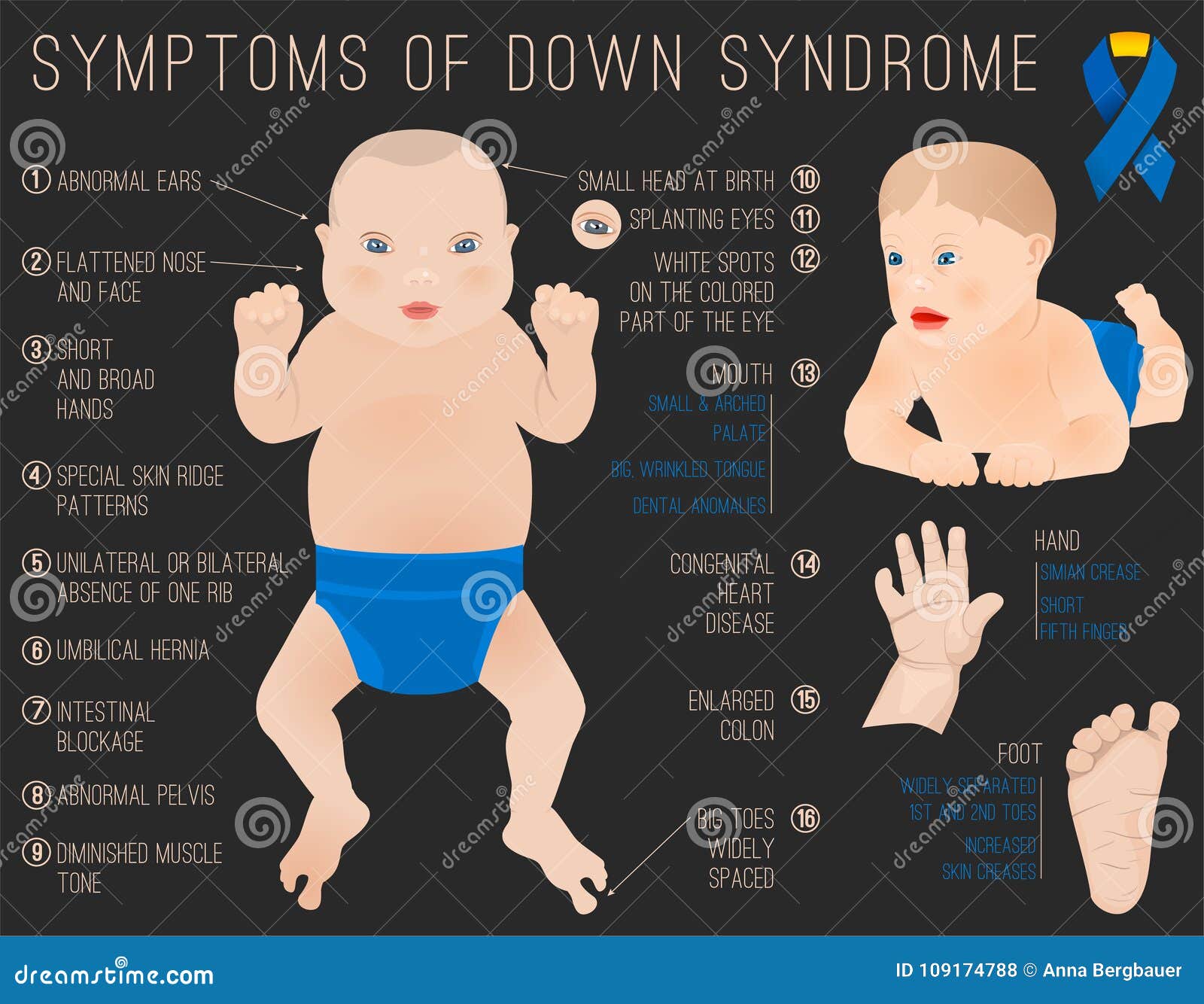 Syndrom down Down Syndrome