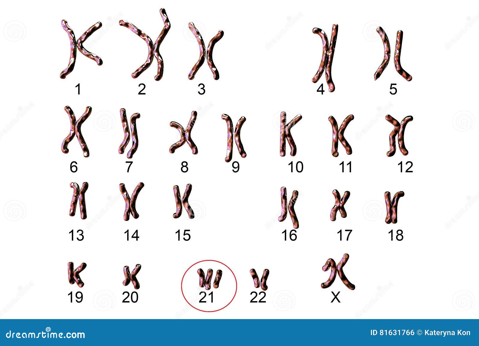 Nondisjunction and chromosomal anomalies