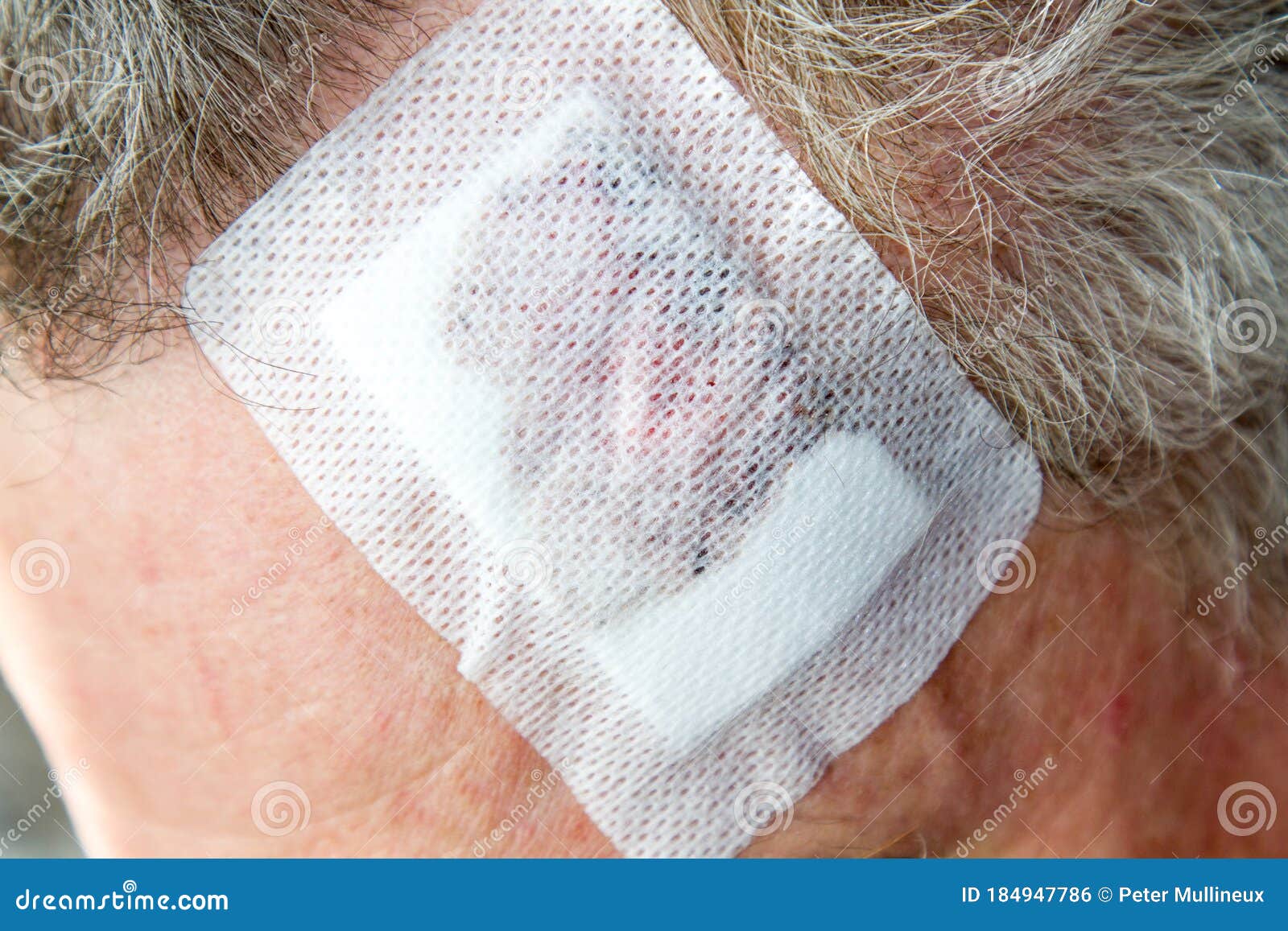 dre of a lentigo maligna, melanoma in situ on the forehead of a 64 year old man