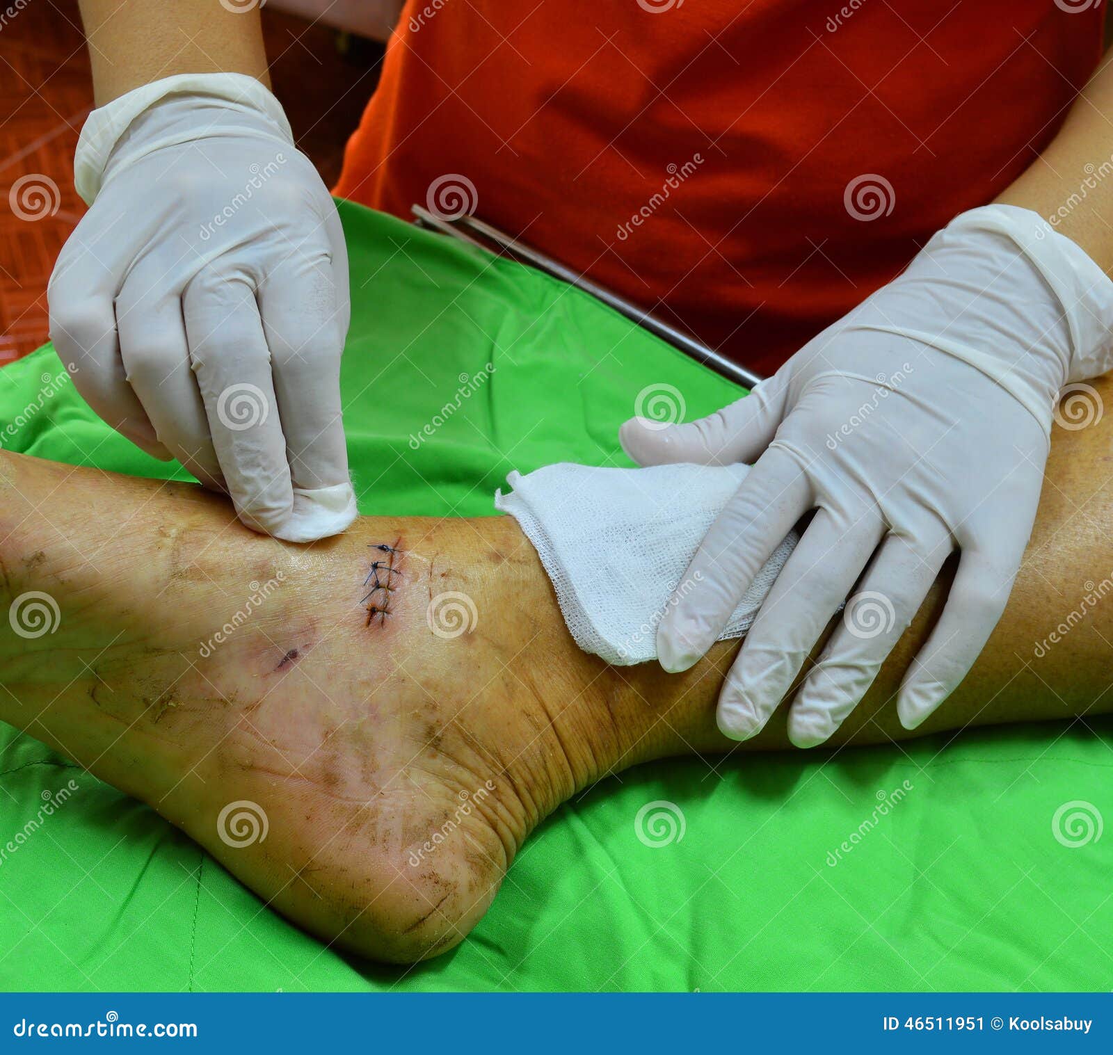Dressing wound sutured. stock image. Image of stitches 46511951