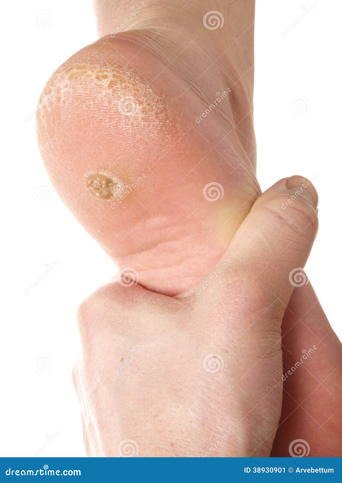 Kinderrijmpjes Verlenen Beneden afronden Droge huid onder voet stock afbeelding. Image of greep - 38930901