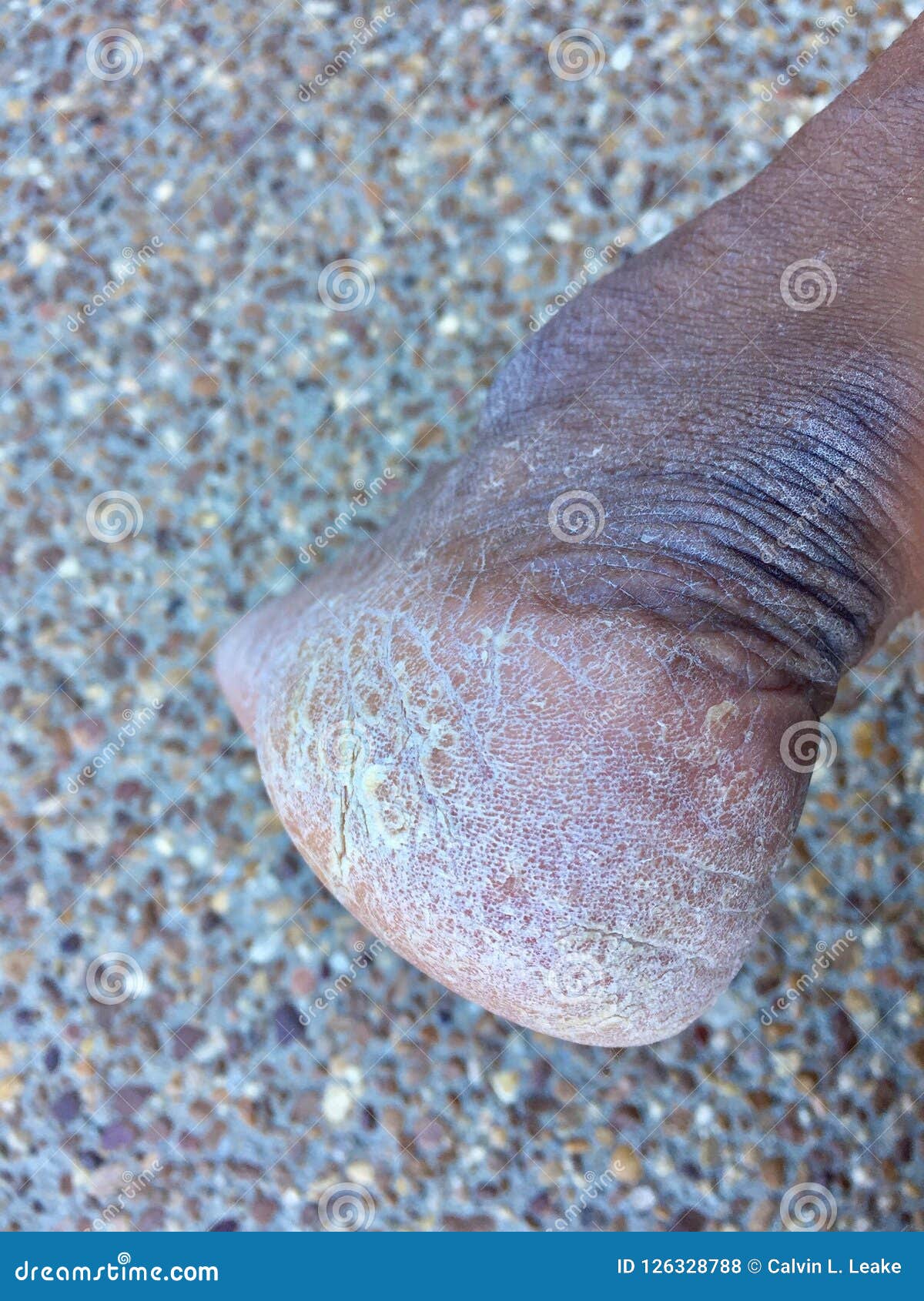 Dry Cracking Brittle Skin stock photo. Image of feet 126328788