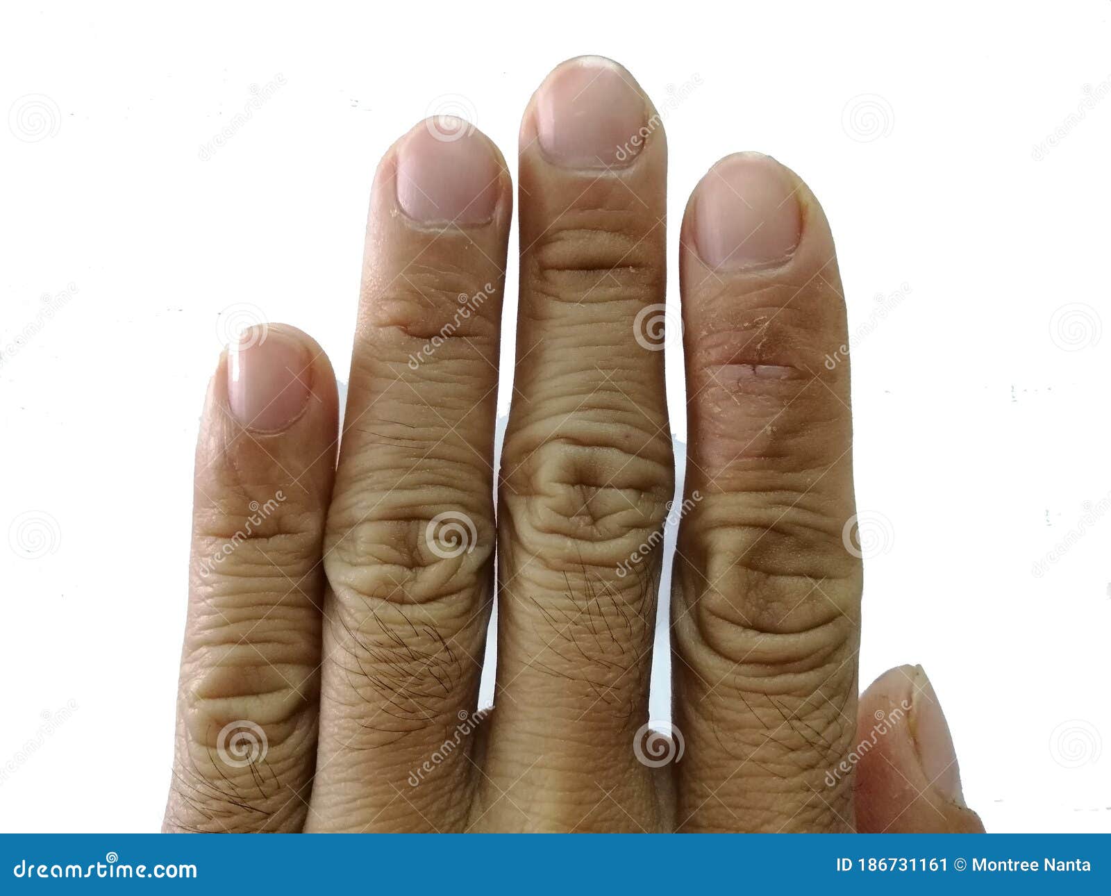 Swollen Peeling Fingertips at James Madrigal blog Swollen Peeling Fingertips at James Madrigal blog