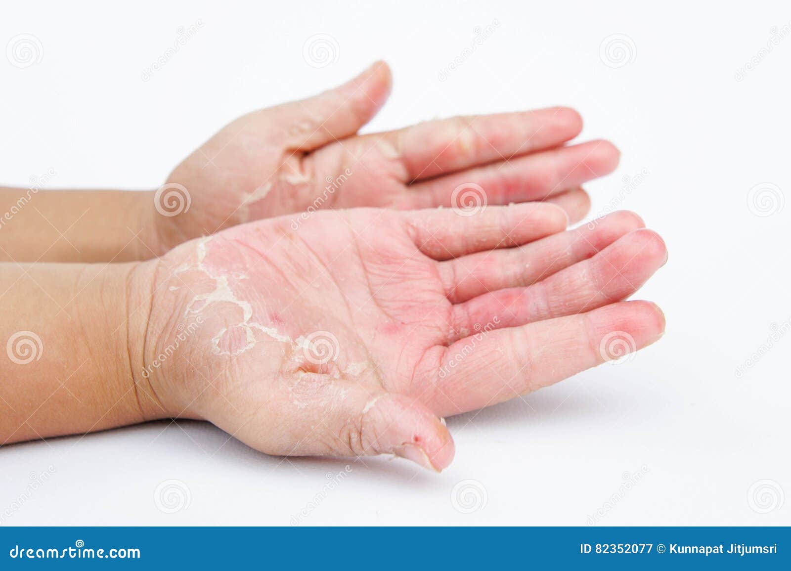the dry hands, peel, contact dermatitis, fungal infections, skin inf