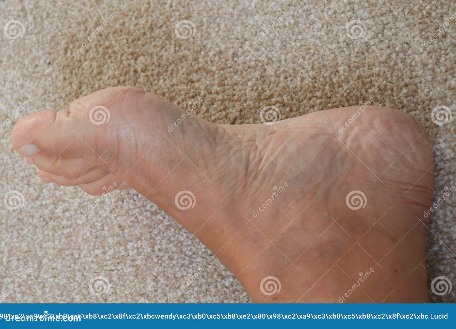 Sore Cracked Dry Skin On Feet Dry Dehydrated Feet Of A Lady Stock Image