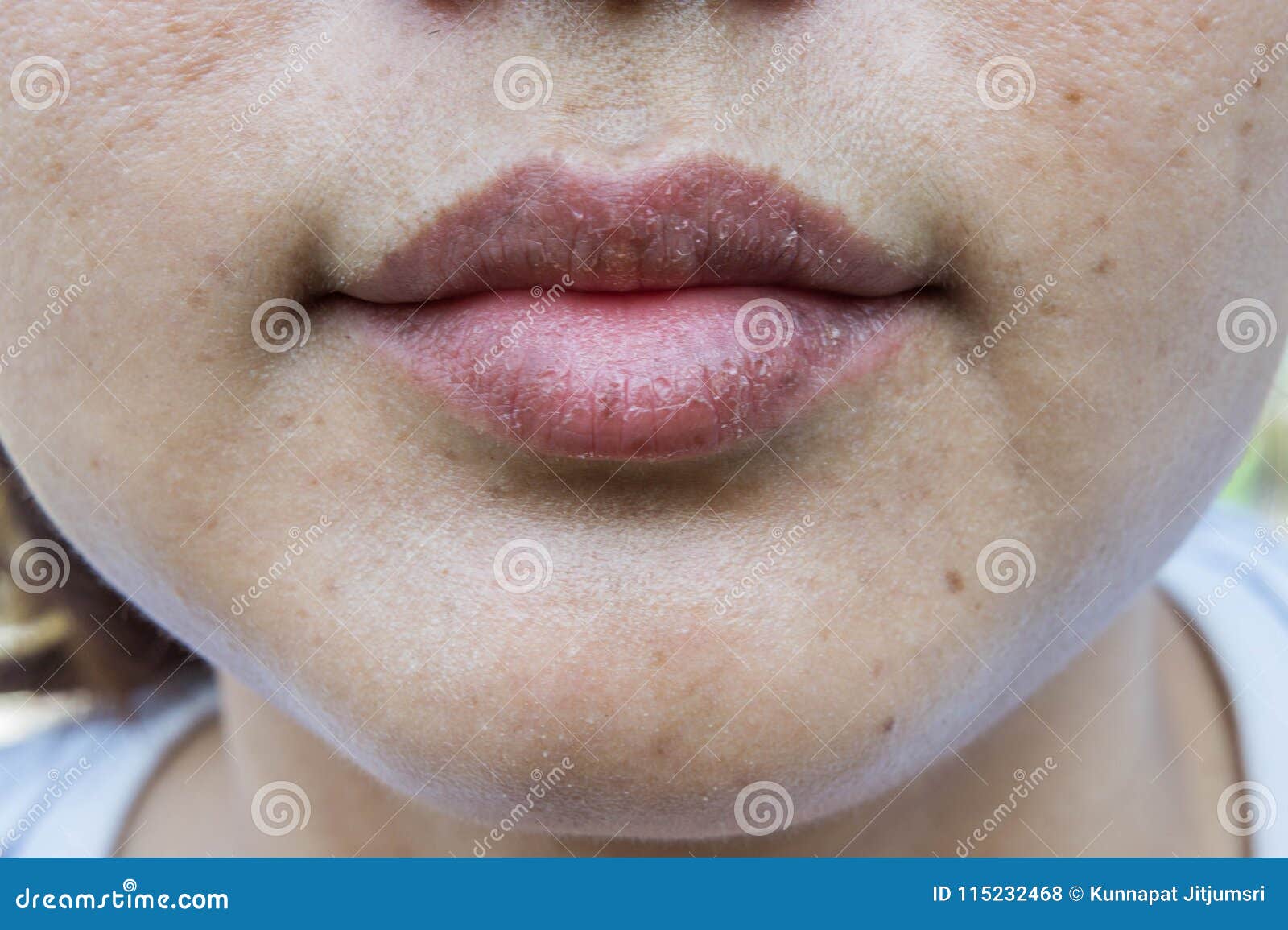 dry lips, lack of skin lips maintenance