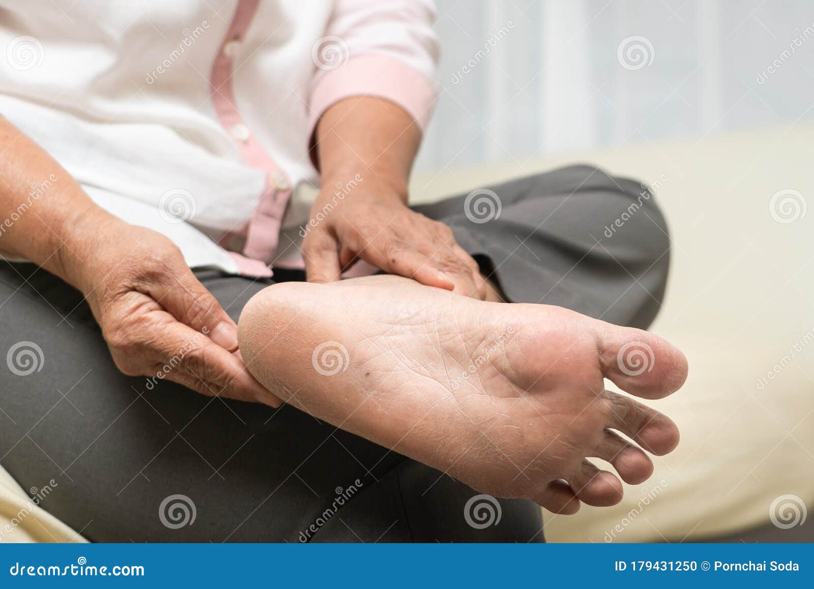 dry skin and cornea on senior woman foot