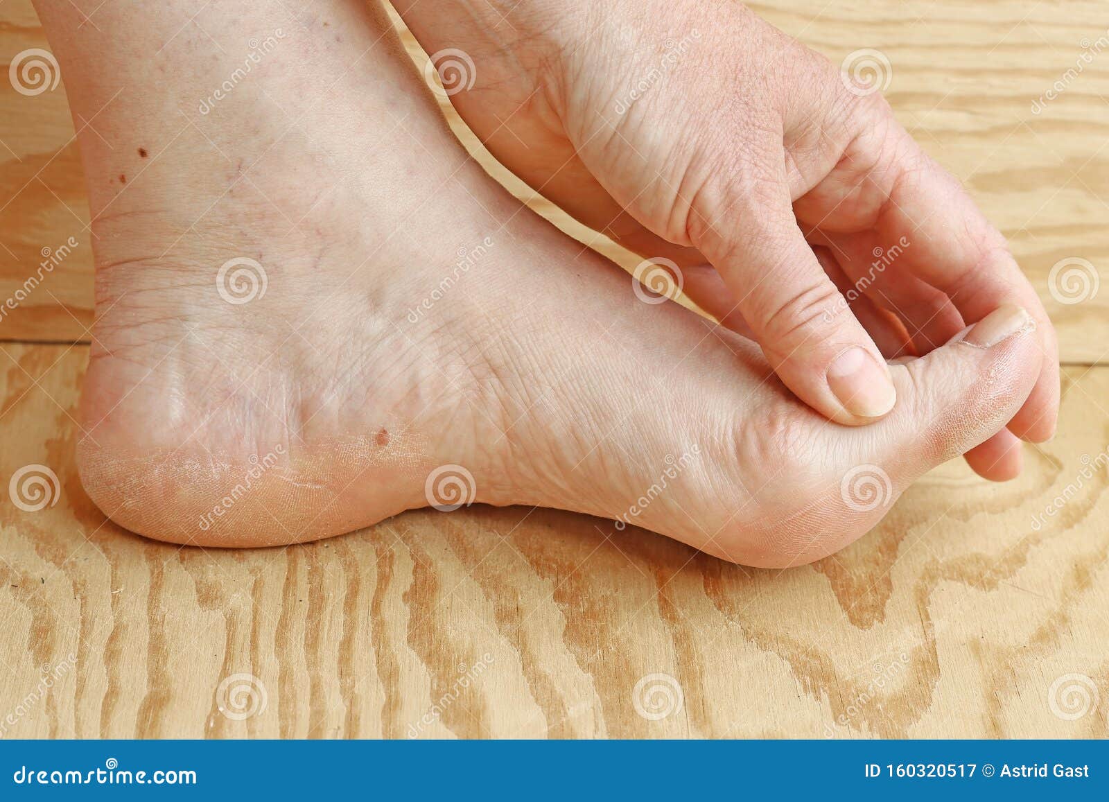 dry skin and cornea on toes and heel of a woman