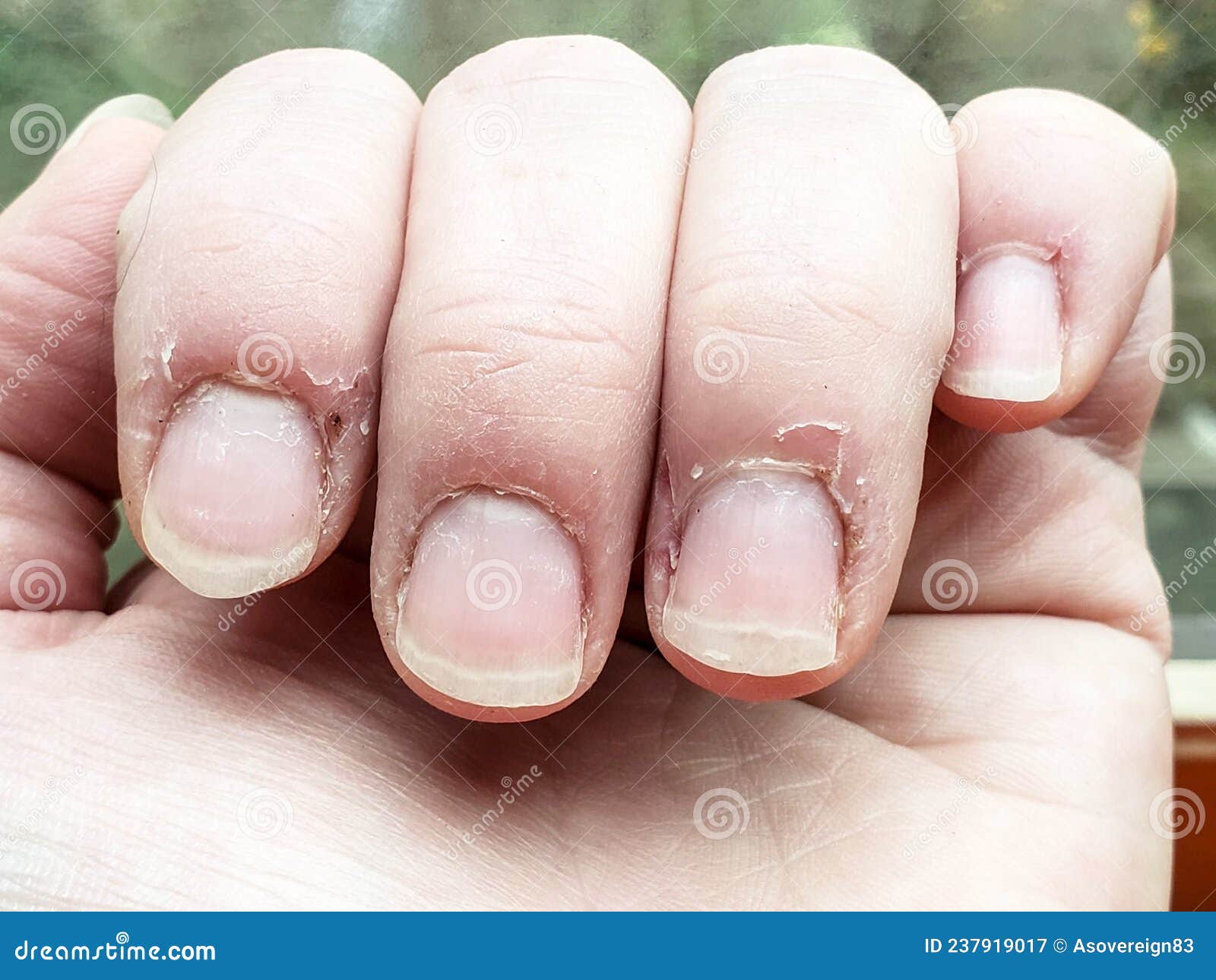 Dry Winter Hands in Need of Manicure. Stock Image Image of cracked