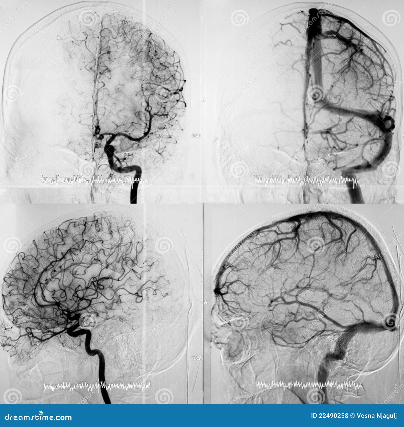 DSA of the Cranial Circulation, Both Phases Photo - of human, artery: