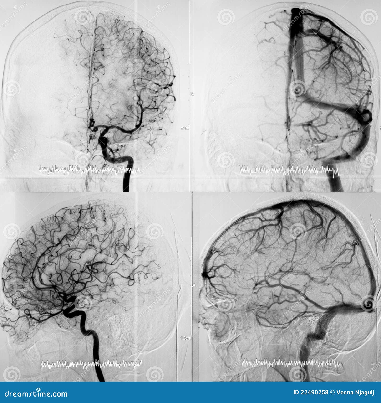 dsa of the cranial circulation, both phases