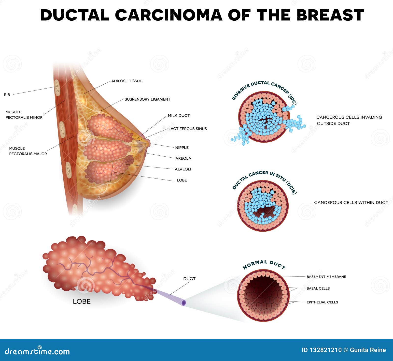 ductal breast cancer