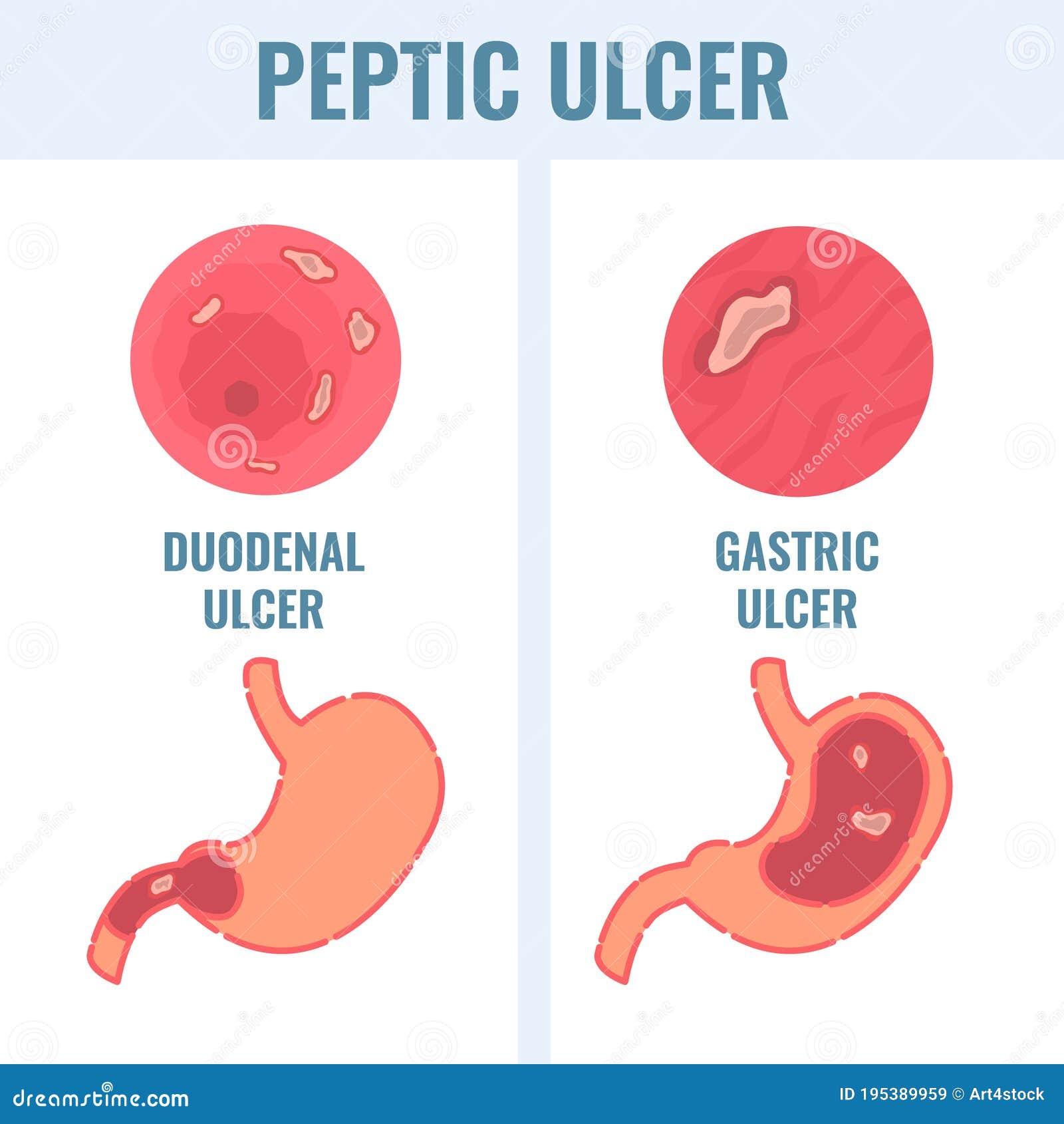 Gastric Ulcer Types