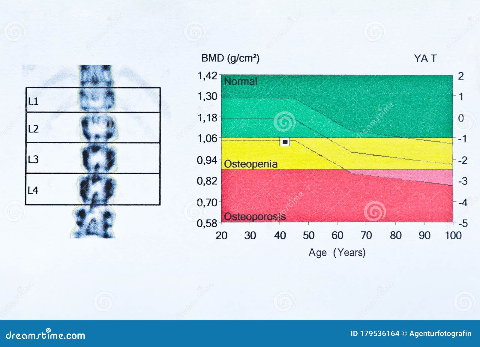 dxa bone density scan spinal column