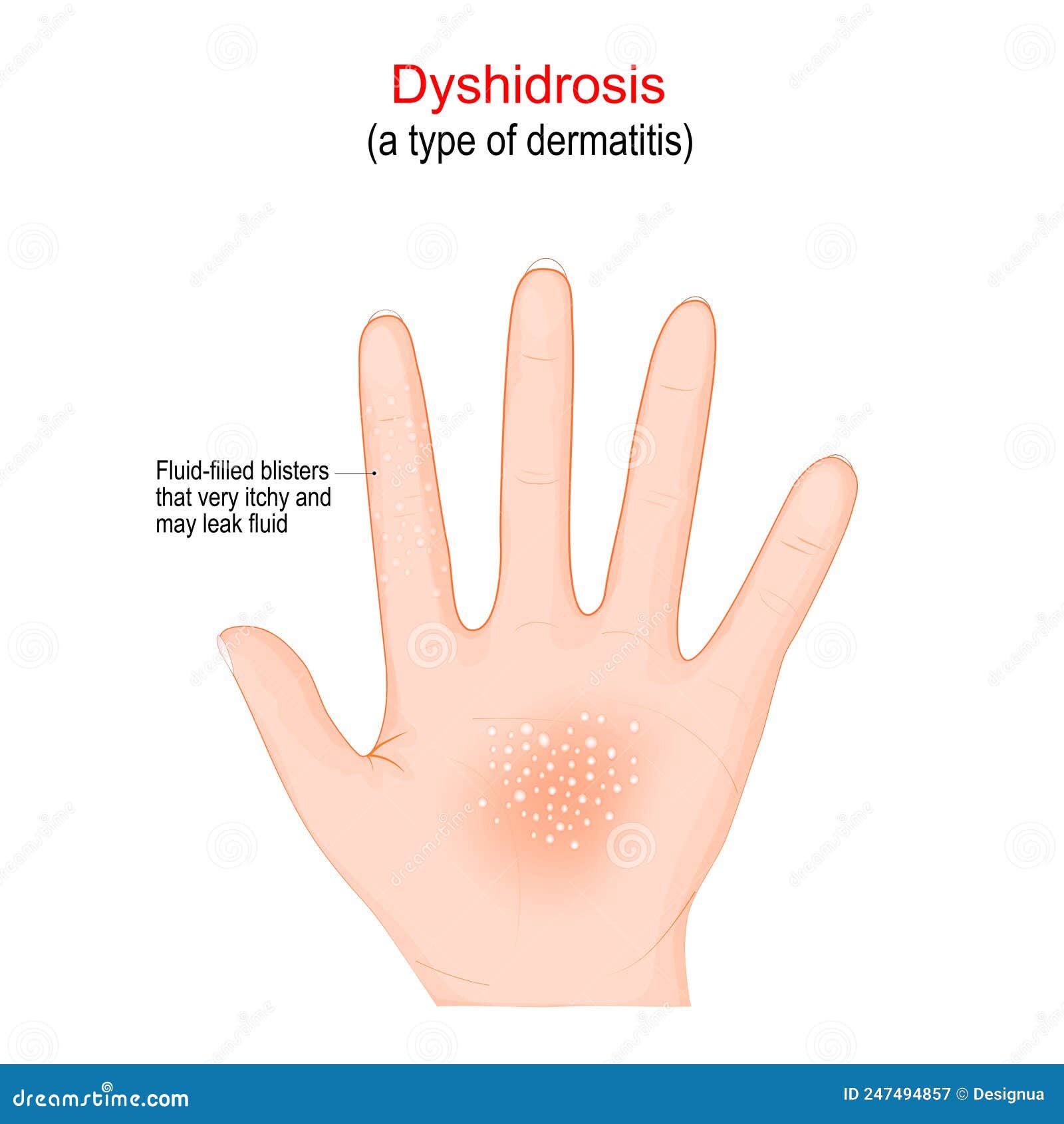 Dyshidrosis Type Of Dermatitis With Itchy Blisters On The Palms Stock