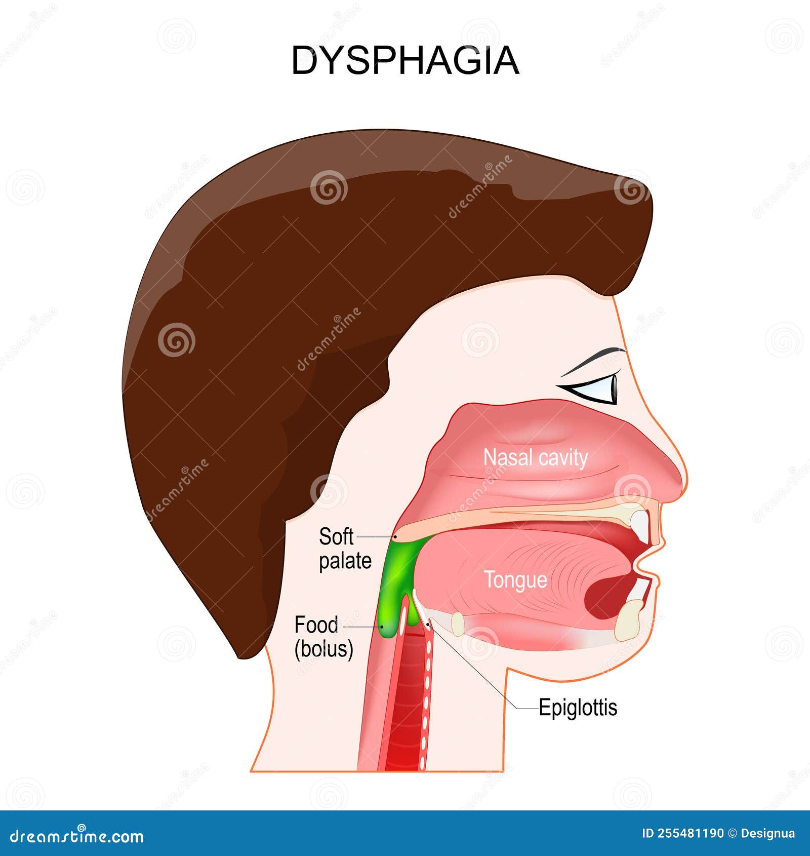 Odynophagia Cartoons Illustrations Vector Stock Images 12 Pictures until-recently-the-cause-of-intermittent-or-progressive-difficulty
