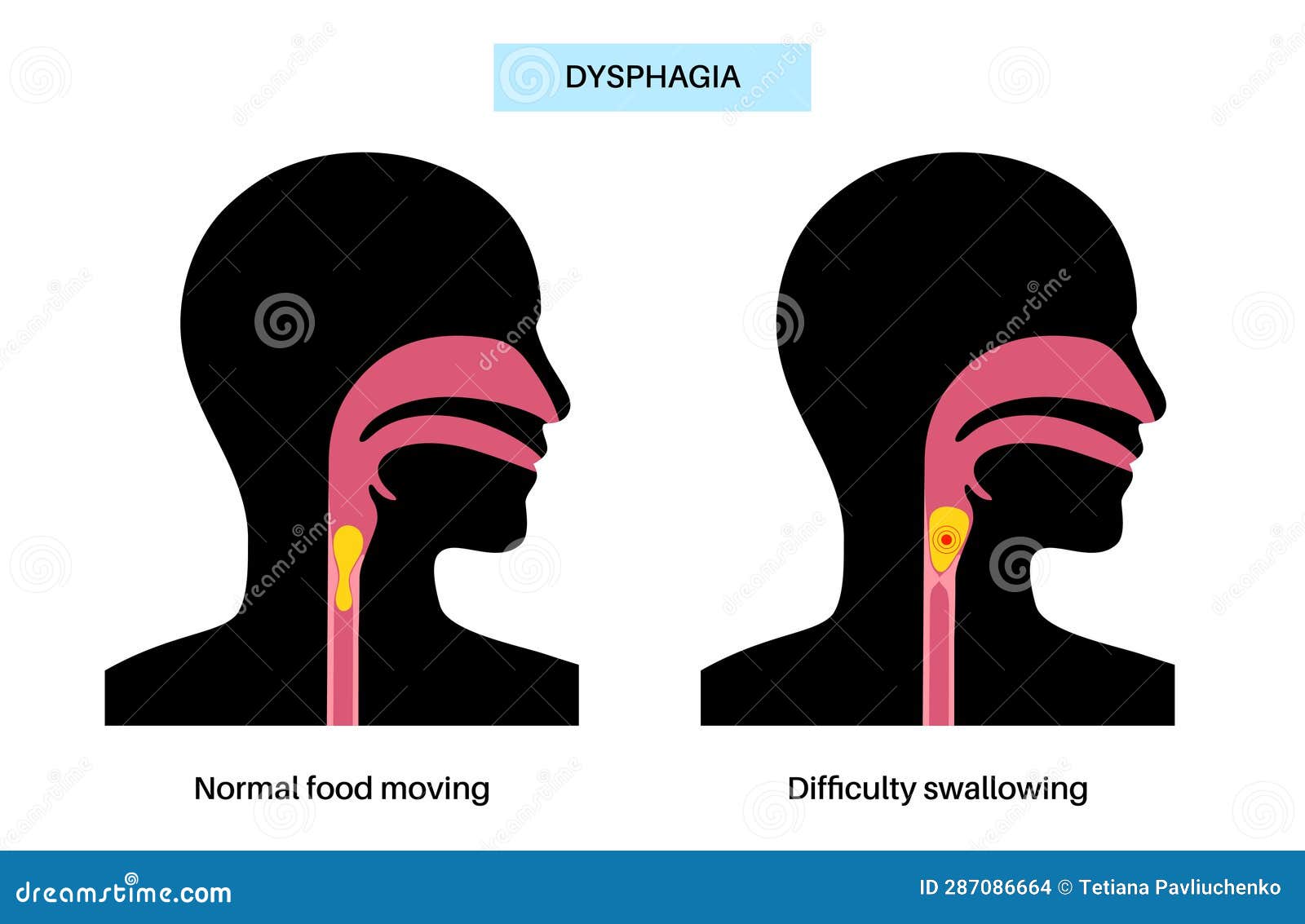 Dysphagia Medical Poster Vector Illustration CartoonDealer 288791532 dysphagia-medical-poster-vector-illustration-cartoondealer-288791532