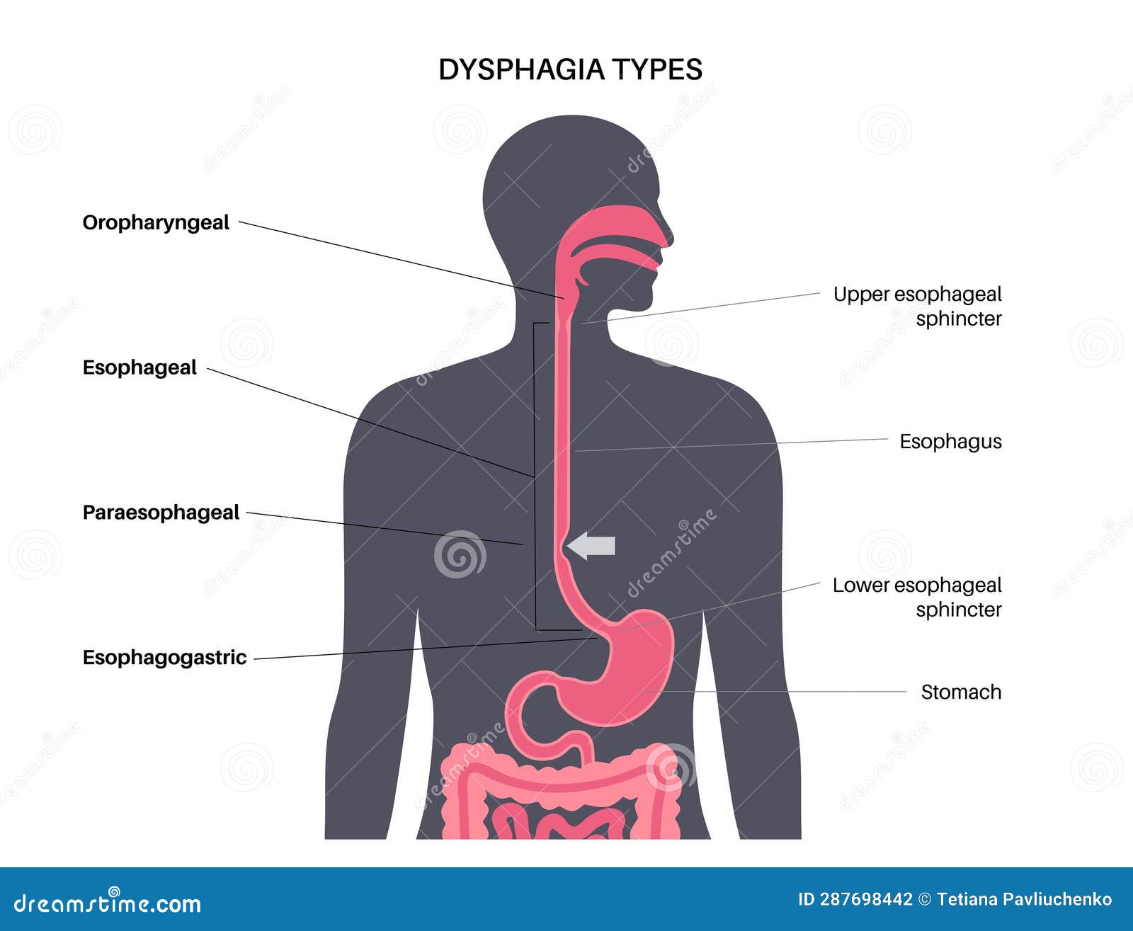 Dysphagia Medical Poster Cartoon Vector CartoonDealer 288003593 dysphagia-medical-poster-cartoon-vector-cartoondealer-288003593