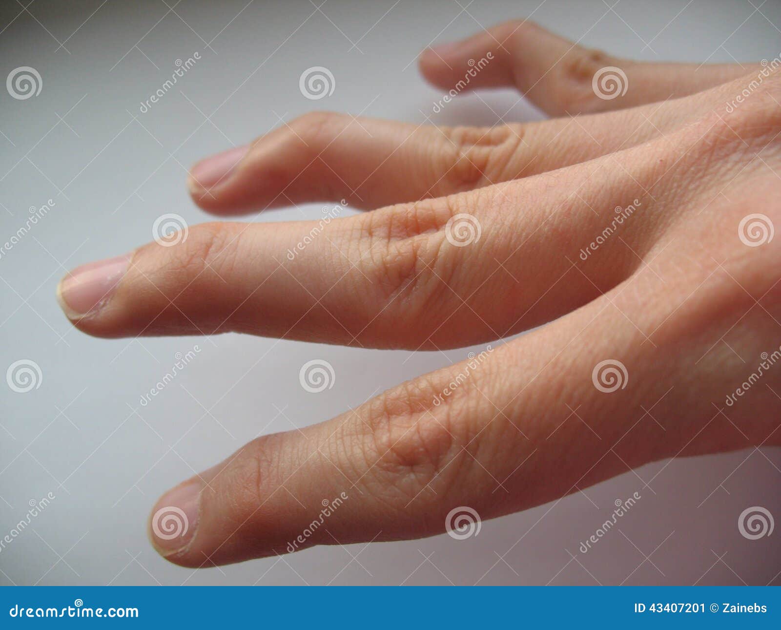 Le défaut de forme de cou de cygne est une position déformée du doigt