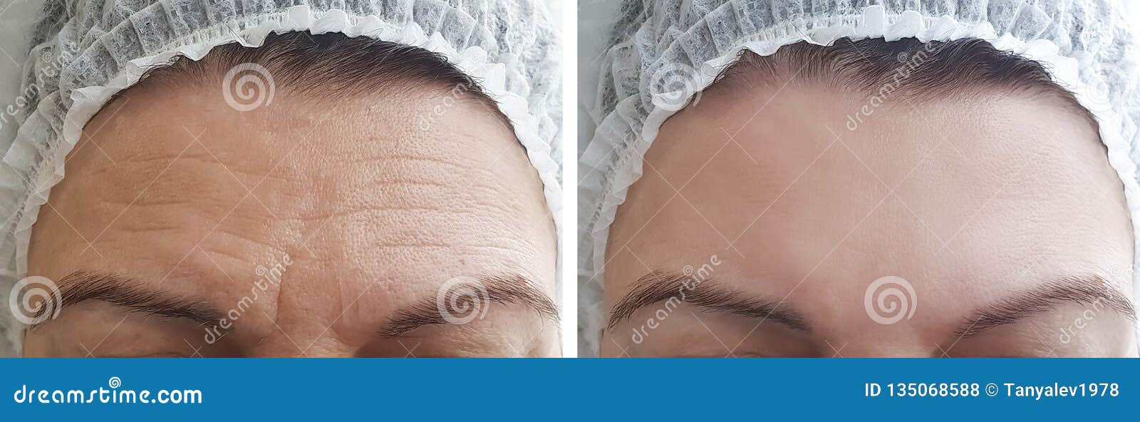 Woman Wrinkles Forehead before and after Procedures Foto de Stock Imagem de dermatologia