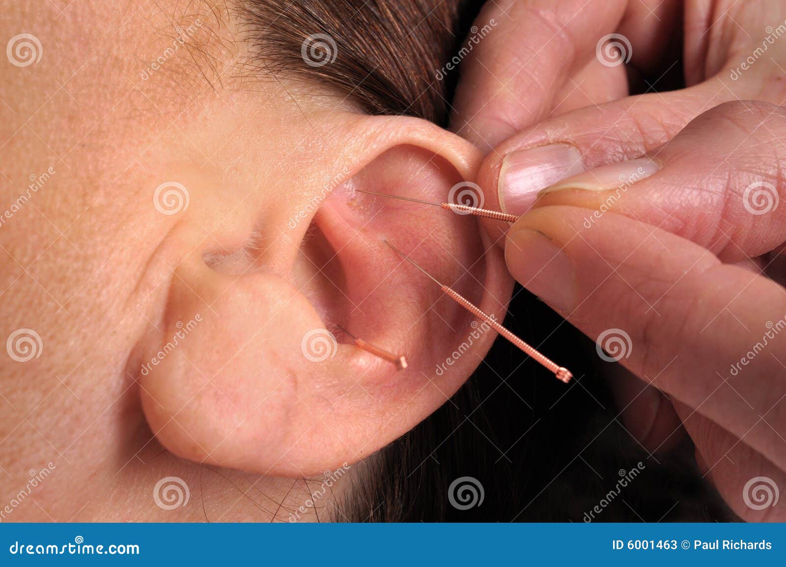 Ear acupuncture stock image. Image of health, face, acupuncture 6001463