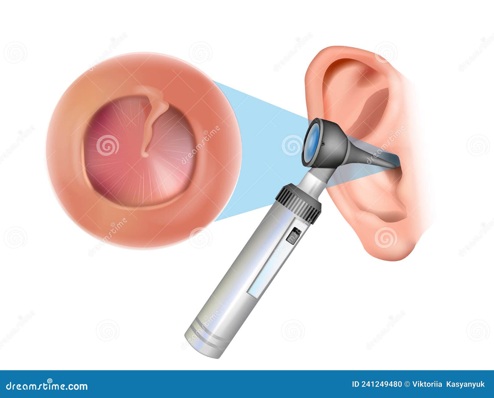ear examination with an otoscope. otitis media with effusion: serous otitis media, secretory otitis media. iinflammation