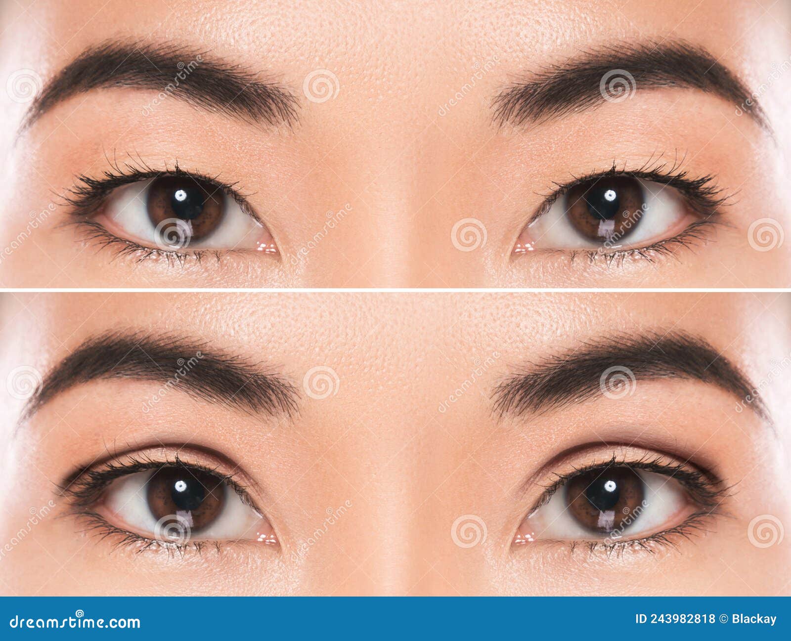 east asian blepharoplasty or double eyelid surgery