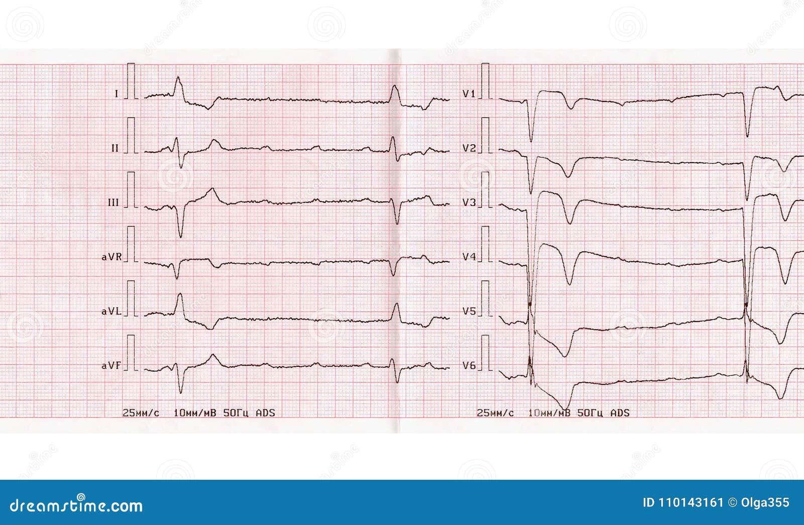 Ecg Com Período Agudo De Enfarte Do Miocárdio Bloqueio