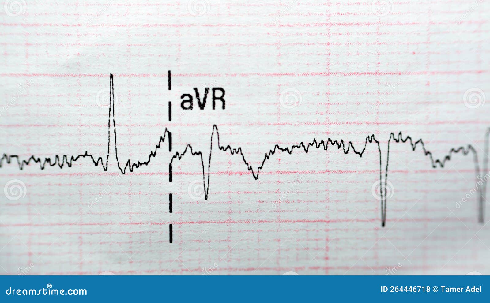 ECG ElectroCardioGraph Paper that Shows Normal Sinus Rhythm NSR with ...