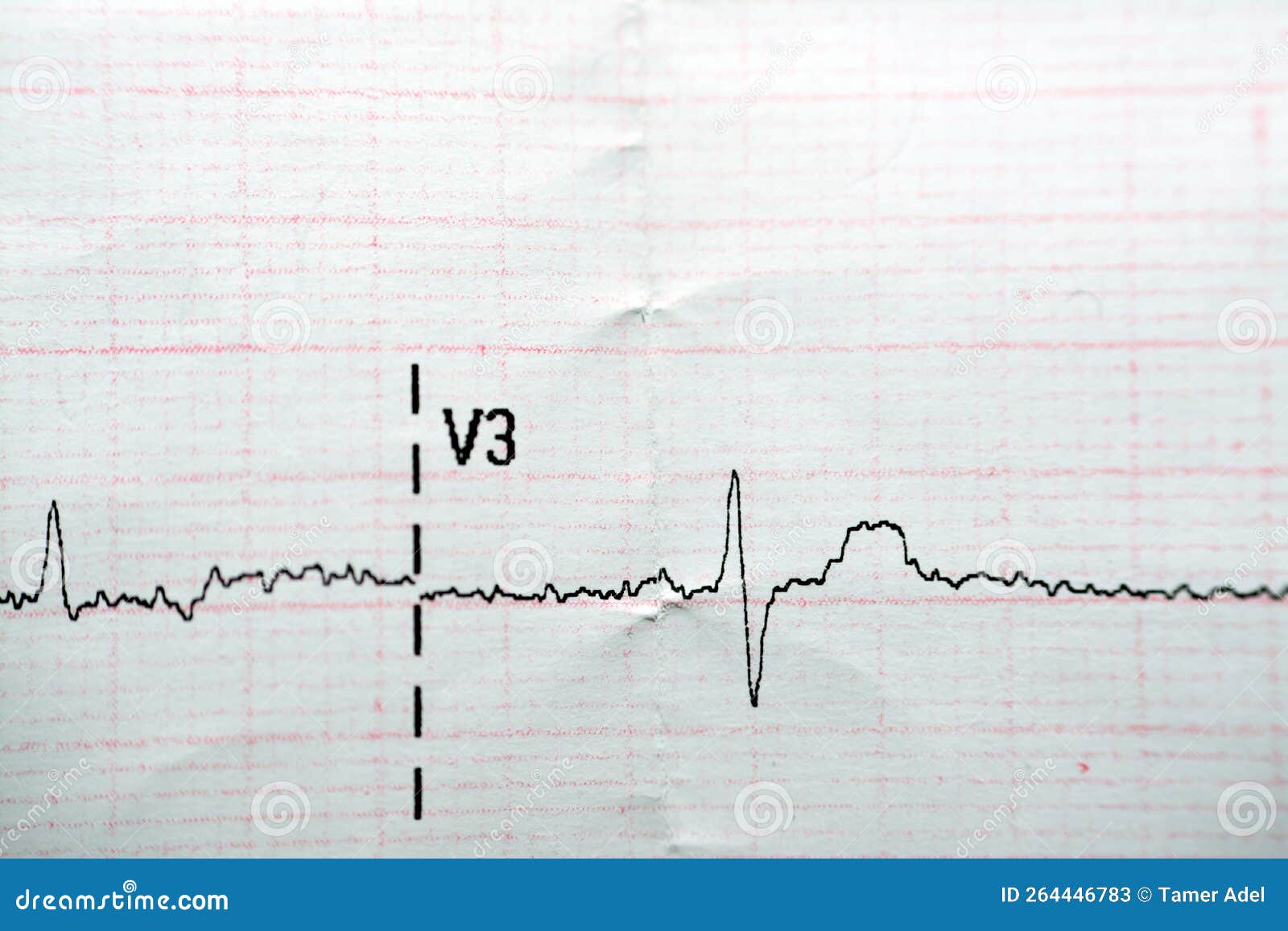 ECG ElectroCardioGraph Paper that Shows Normal Sinus Rhythm NSR with ...