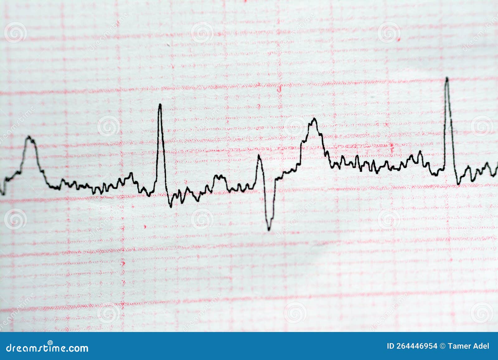 ECG ElectroCardioGraph Paper that Shows Normal Sinus Rhythm NSR with ...