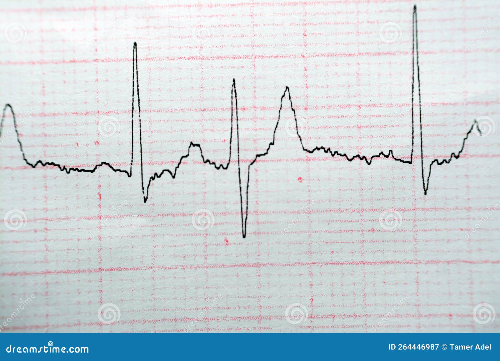 ECG ElectroCardioGraph Paper that Shows Normal Sinus Rhythm NSR with ...