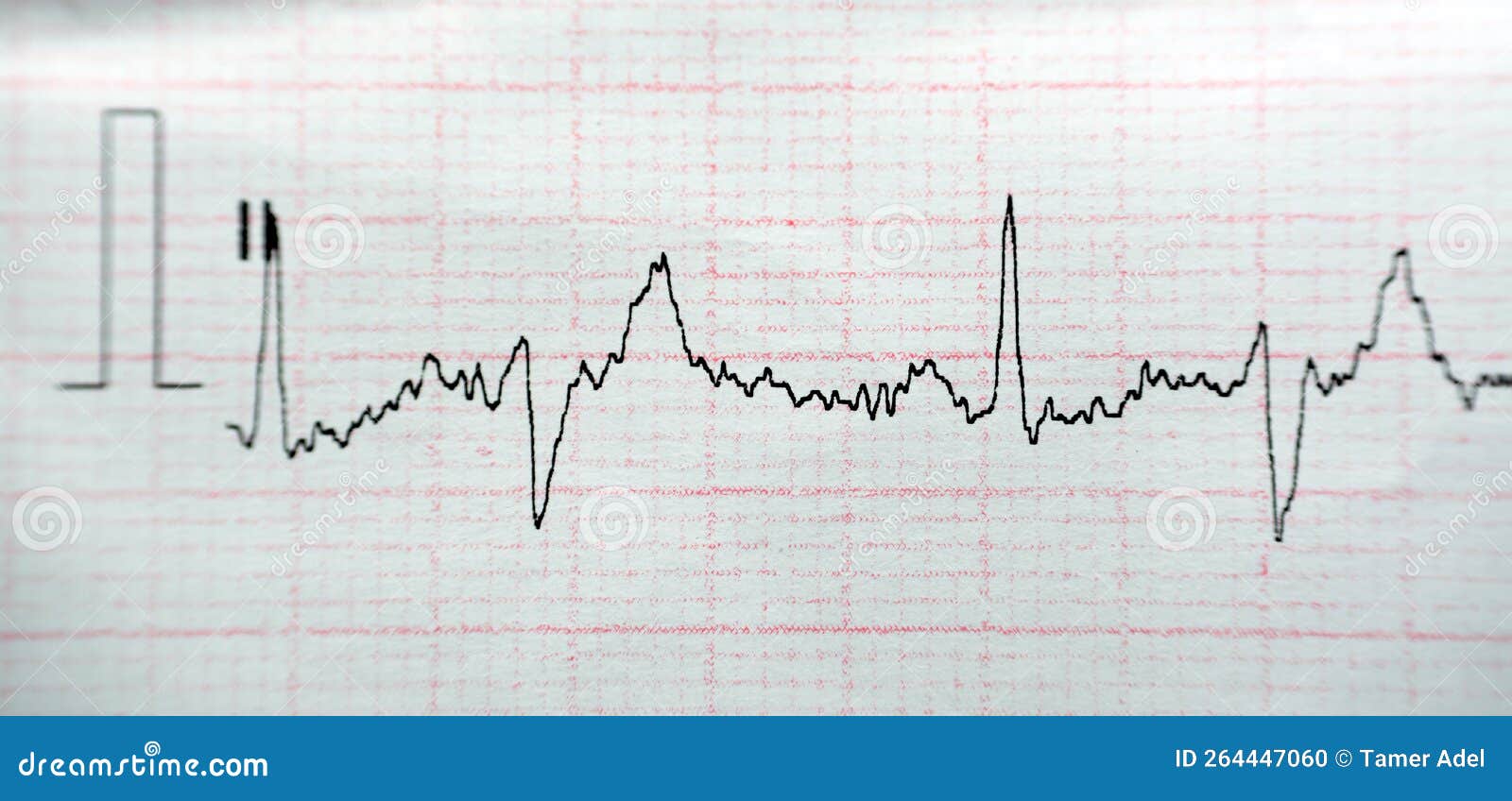 ECG ElectroCardioGraph Paper that Shows Normal Sinus Rhythm NSR with ...