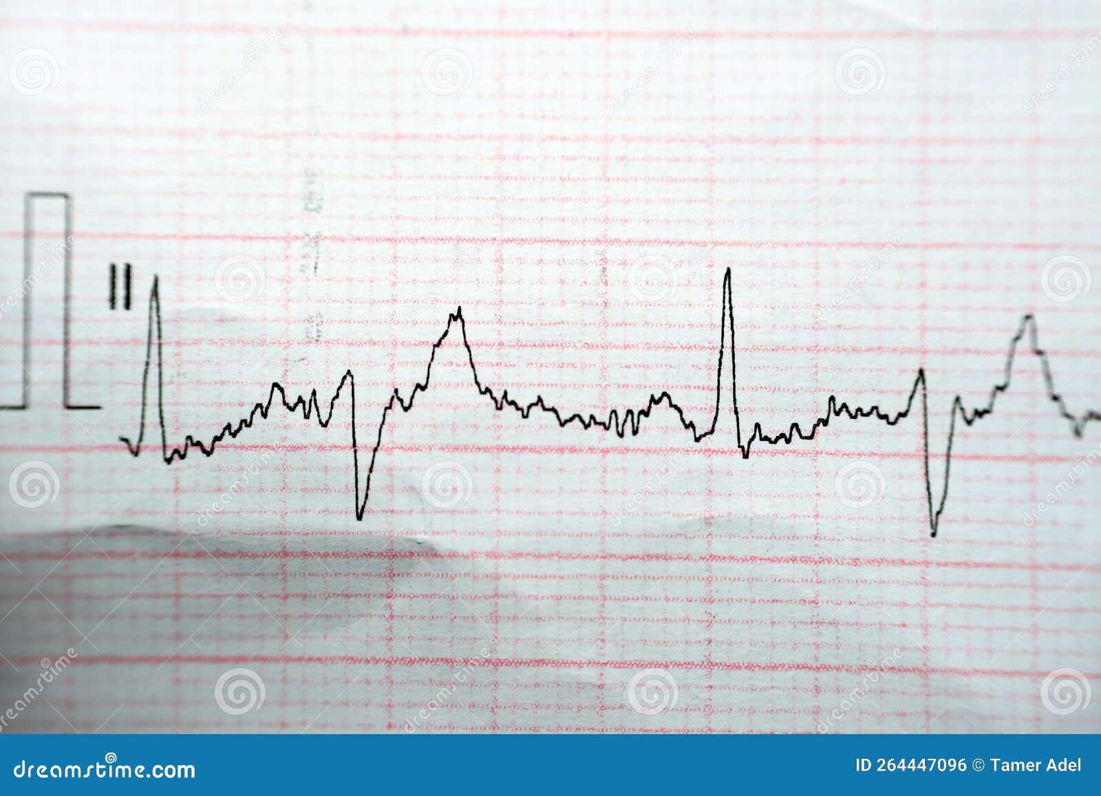 ECG ElectroCardioGraph Paper that Shows Normal Sinus Rhythm NSR with ...