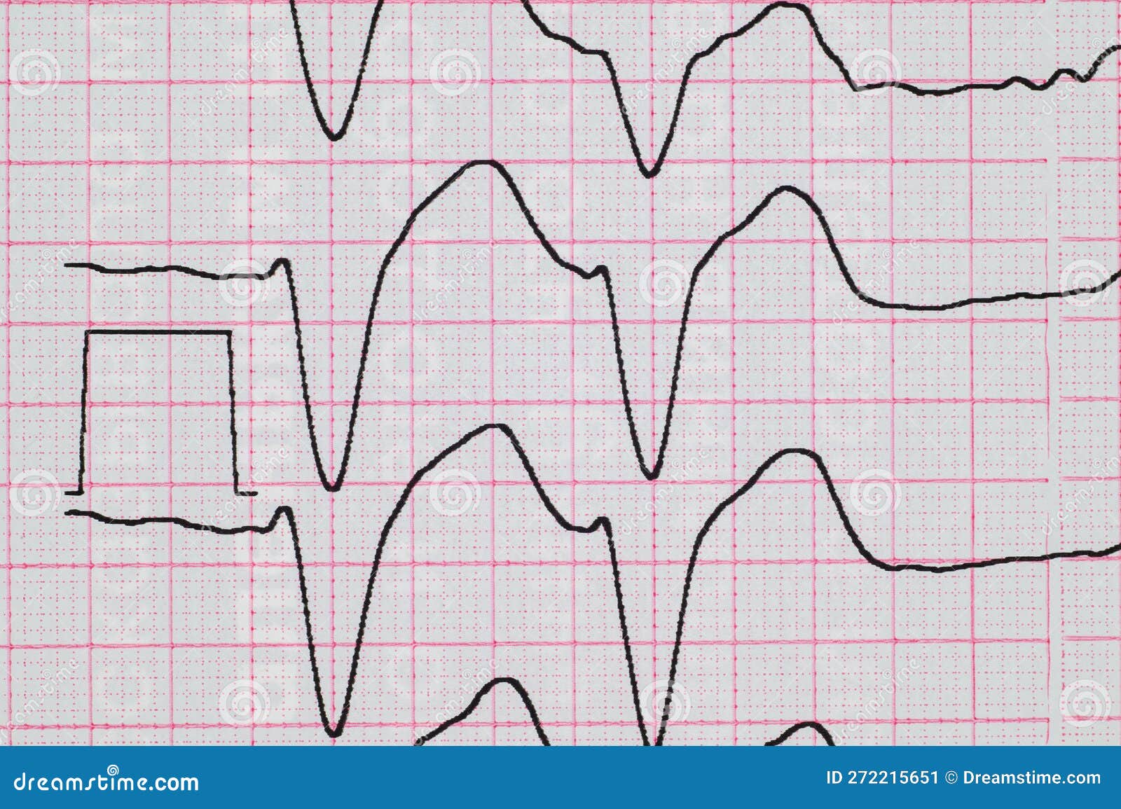ECG With Rhythm Disturbance Ventricular Extrasystole Close up ecg-with-rhythm-disturbance-ventricular-extrasystole-close-up