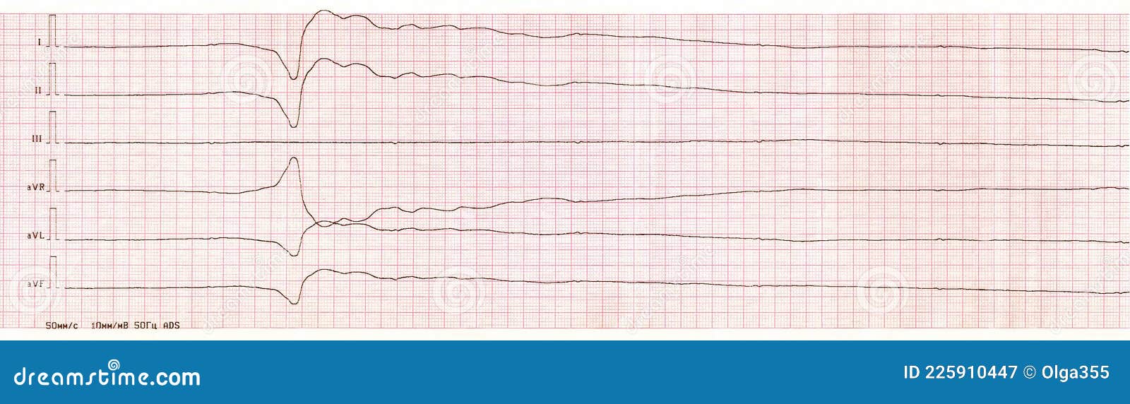 Asystole meaning