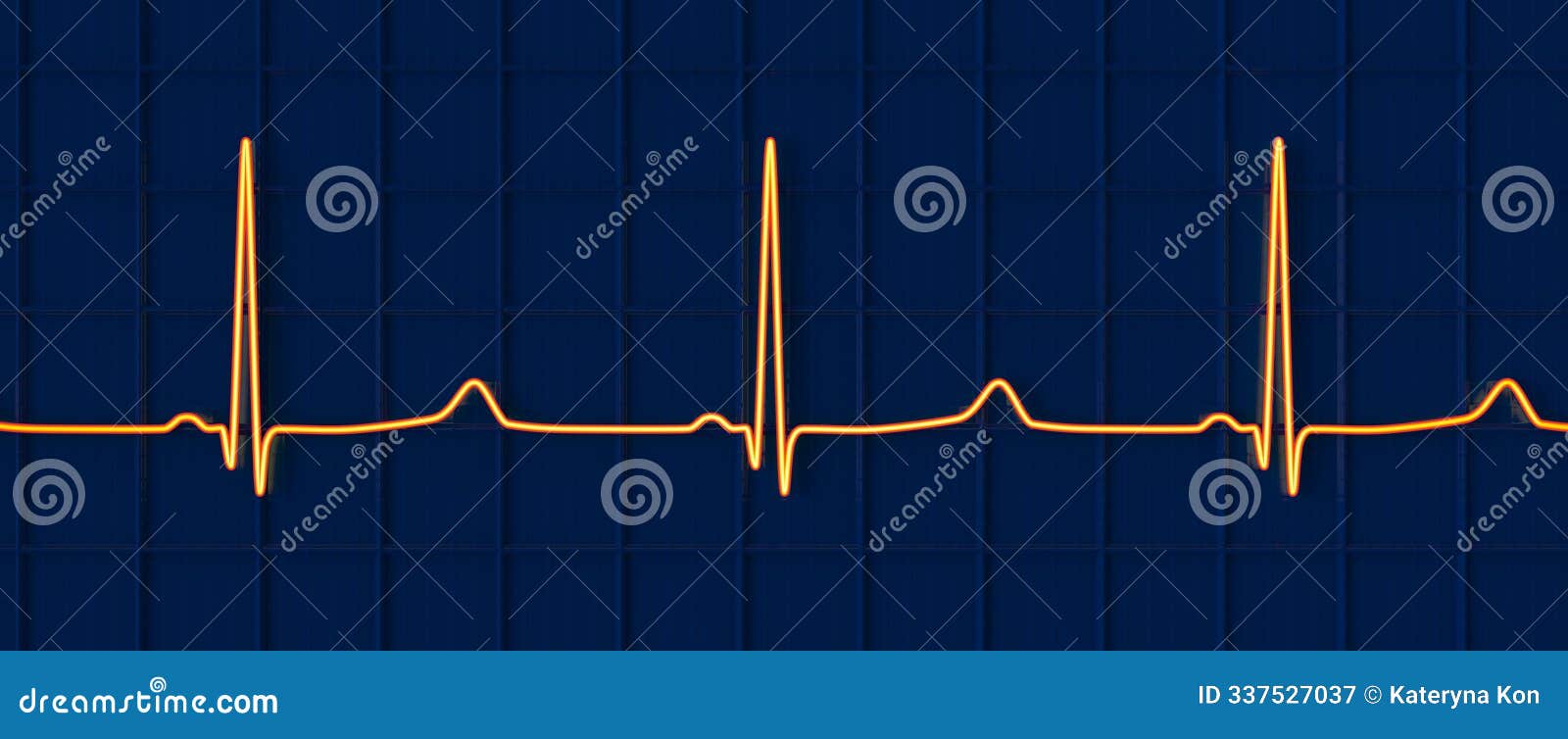 ecg of type 3 long qt syndrome, 3d 