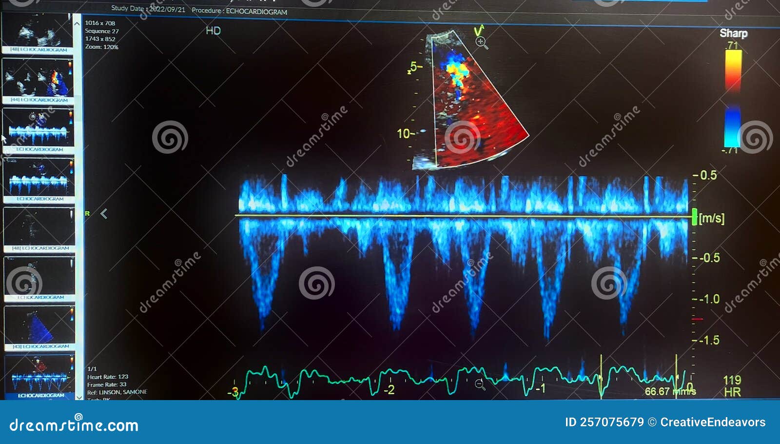 echocardiogram colorful probe targeting map and waveforms