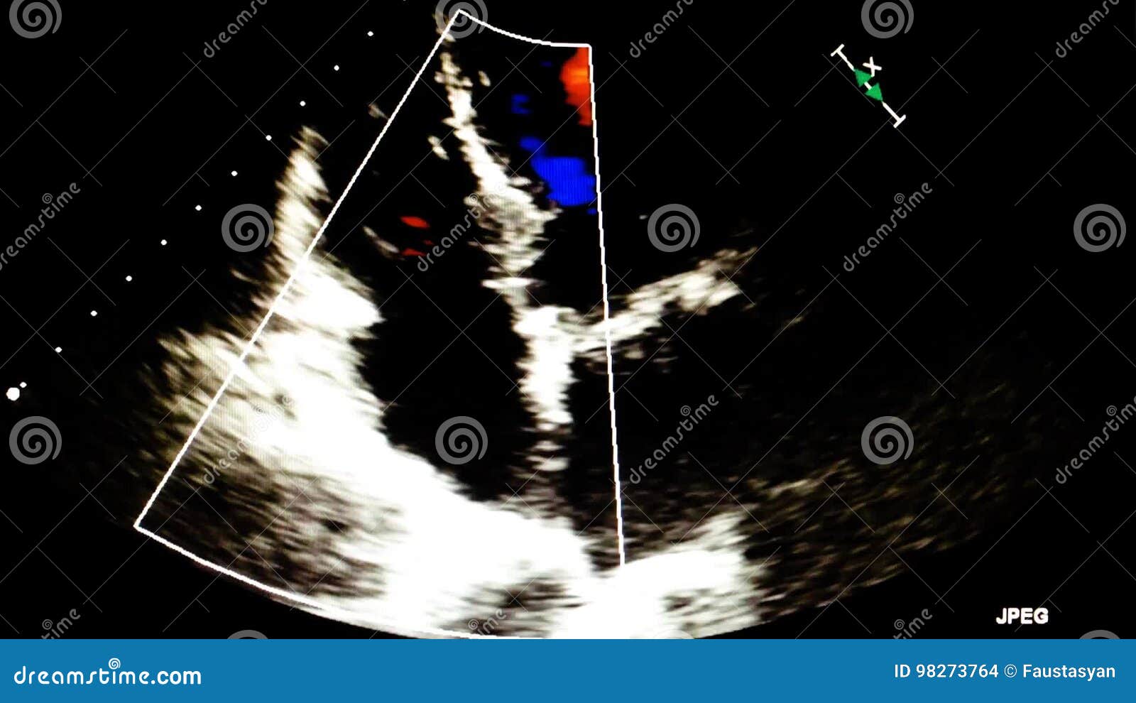 Echocardiography Ultrasound Examination of the Heart Stock Footage