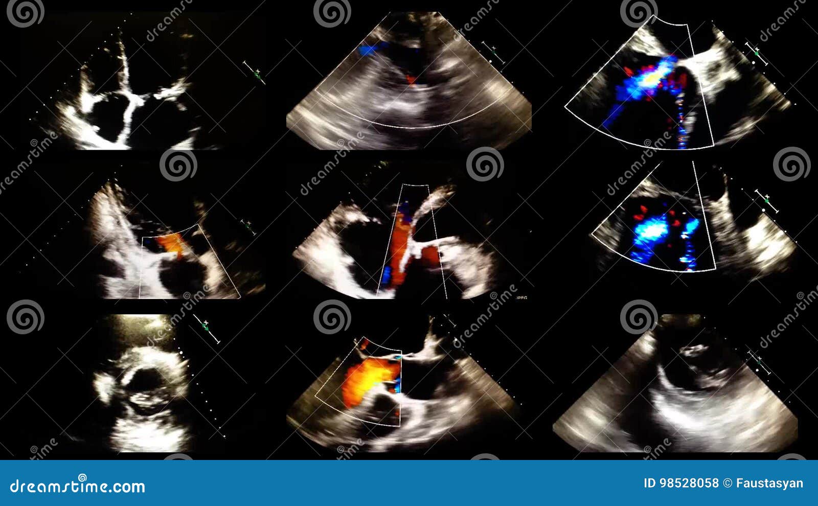 Echocardiography Ultrasound Examination of the Heart Stock Footage